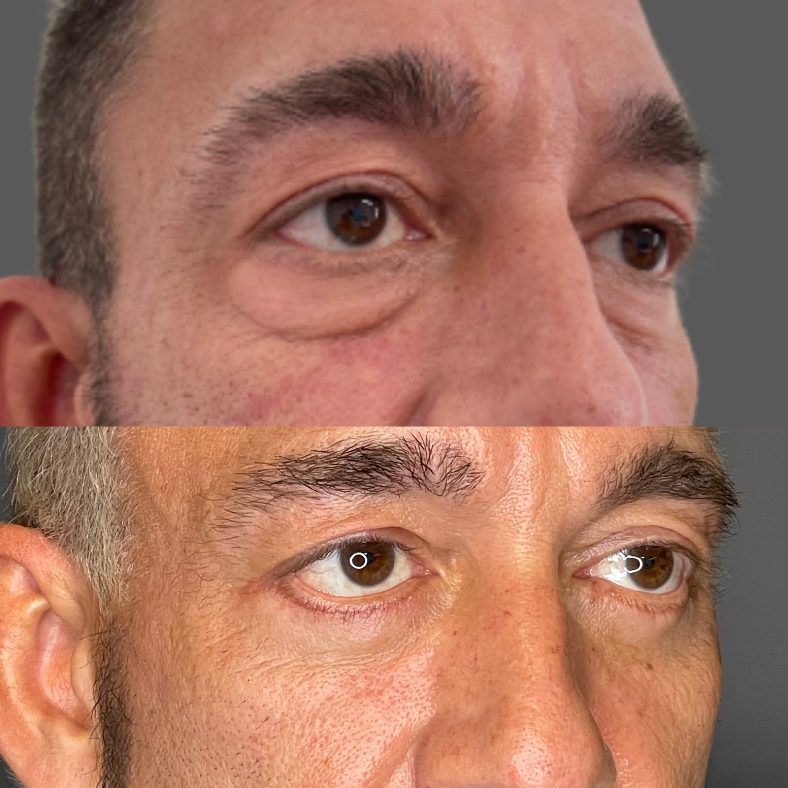 Blefaroplastia Inferior Antes y Después