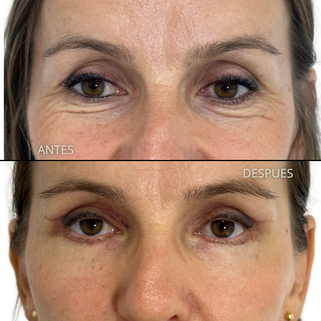 Blefaroplastia Completa Antes y Después - Caso 2
