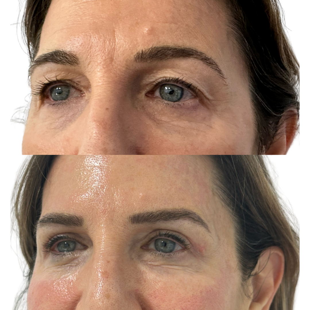 Blefaroplastia Superior Antes y Después - Caso 2