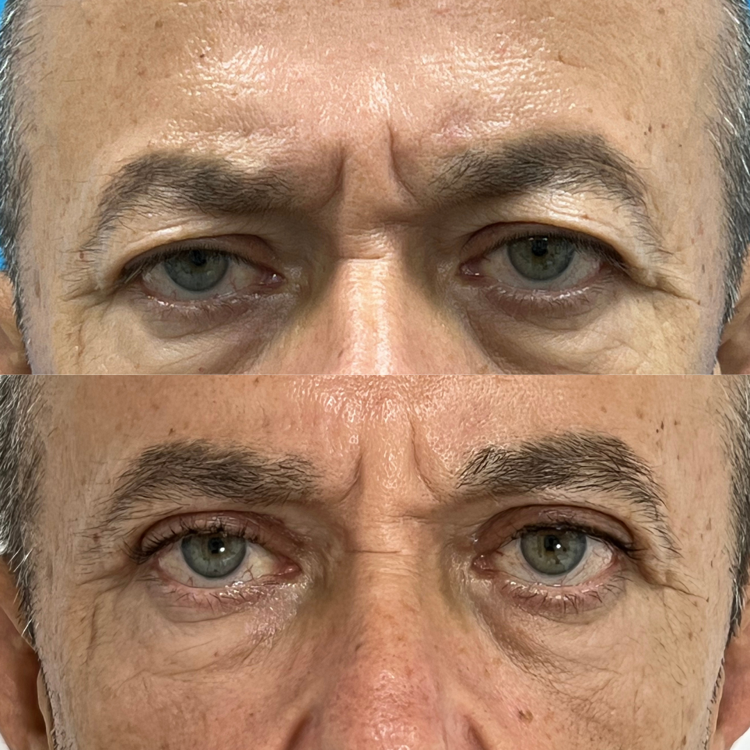 Blefaroplastia Superior Antes y Después - Caso 1