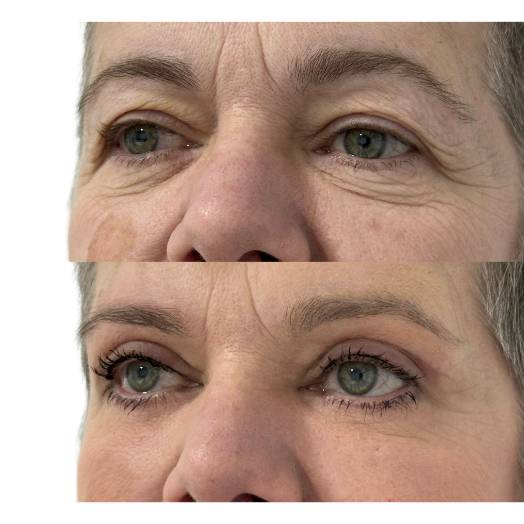 Blefaroplastia Completa Antes y Después - Caso 1