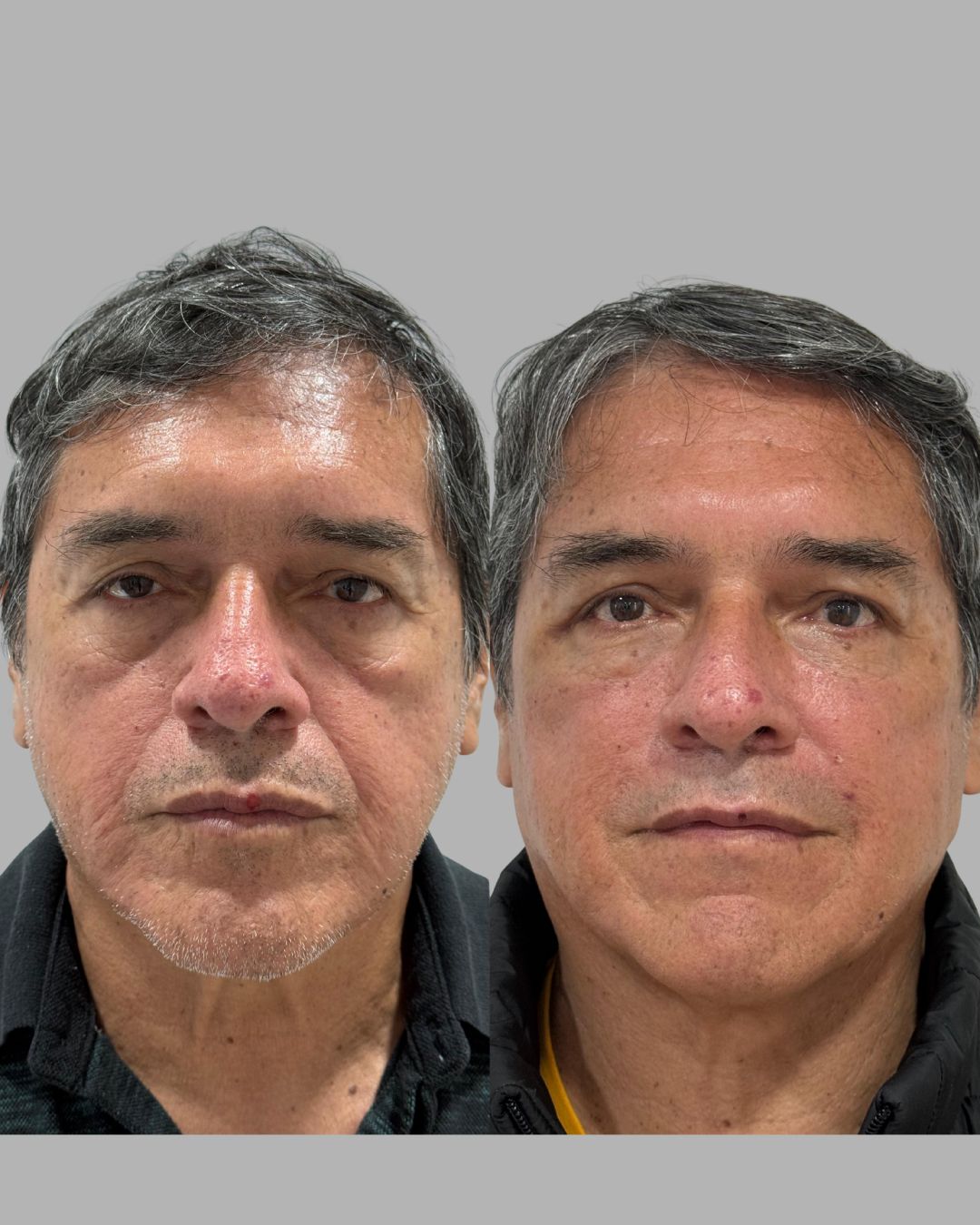 Antes y Después - Caso 3