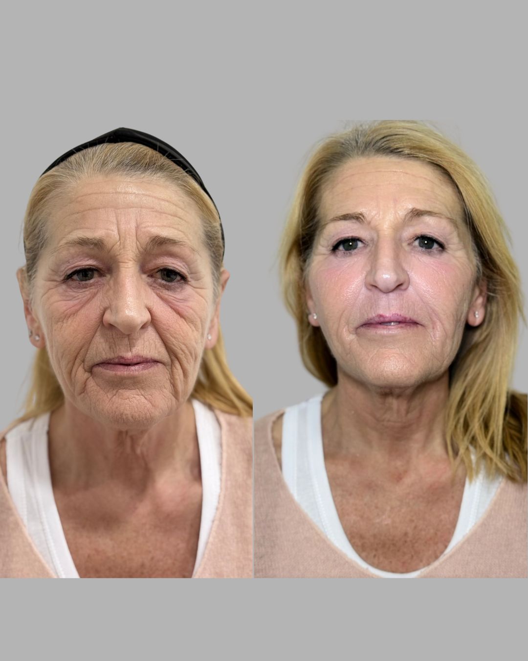 Antes y Después - Caso 4