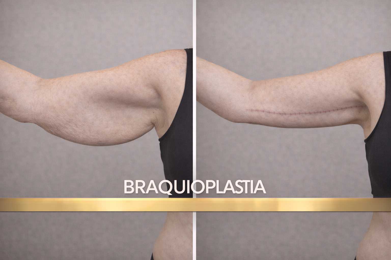 Braquioplastia Valencia - Lifting de Brazos