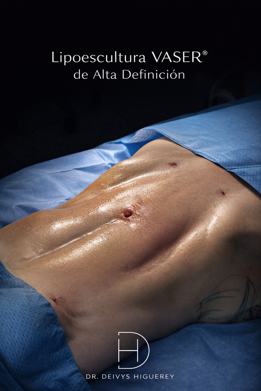 Lipoescultura VASER de alta definición
