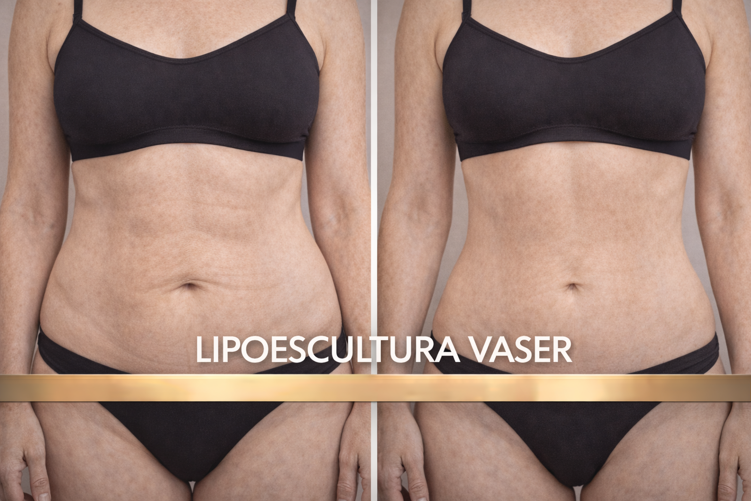Lipoescultura VASER Valencia - Dr. Higuerey