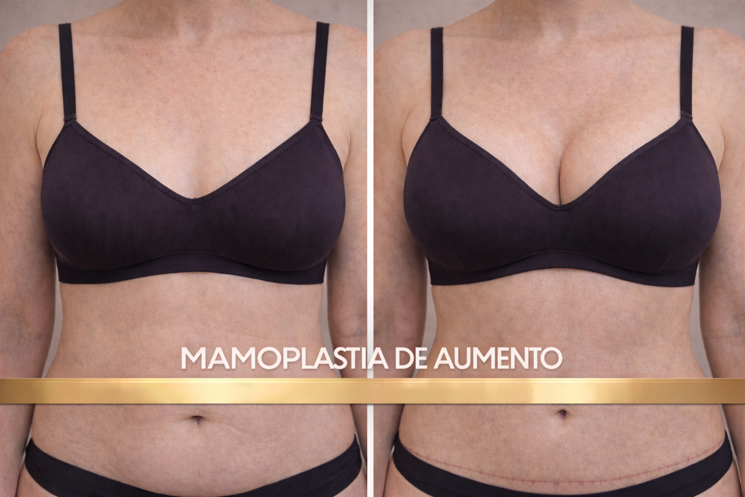 Aumento de Mamas Valencia - Mamoplastia