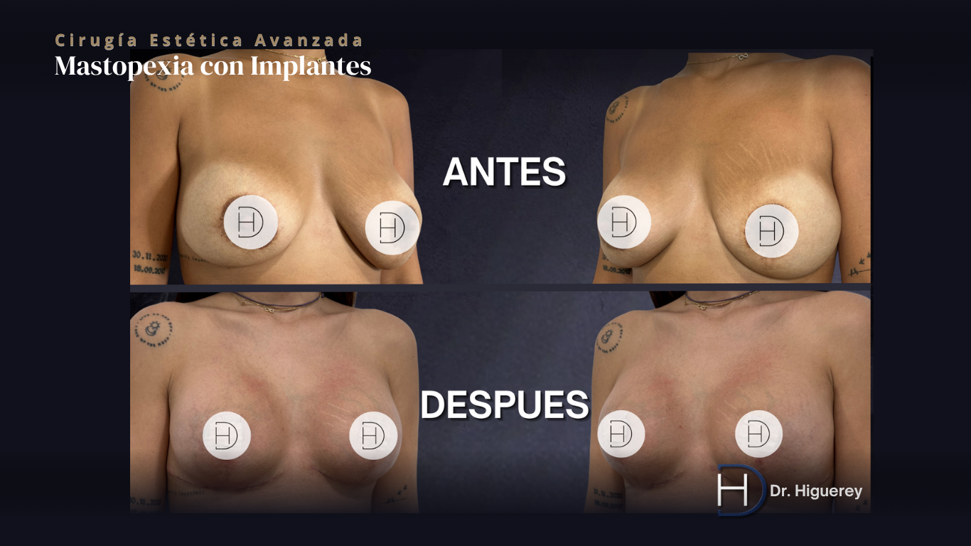 Mastopexia con implantes