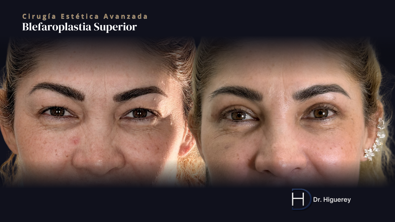 Blefaroplastia superior